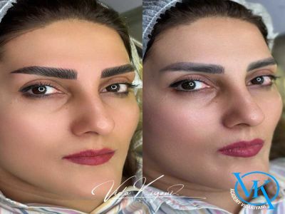 چرا بعضی ها بعد از فیبروز پشیمان می شوند؟