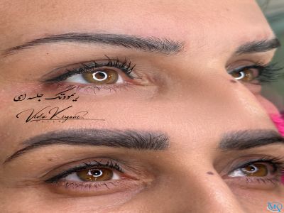 مقایسه ریمو ابرو با لیزر و مواد