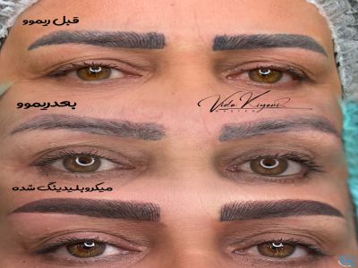 رفع قرمزی بعد از ریموو