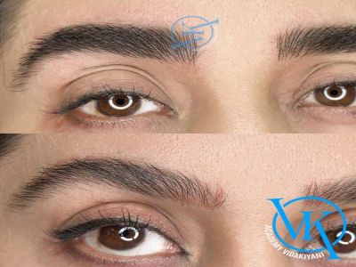 مراقبت های بعد از فیبروز ابرو