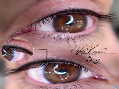 آیا بن مژه باعث ریزش مژه می شود؟