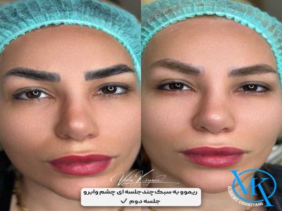 مراقبت های بعد از ریموو ابرو