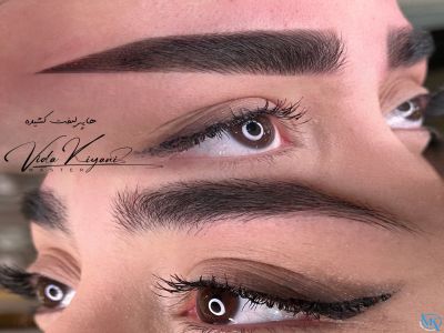 همه چیز درباره هایپرلیفت ابرو